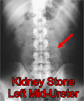 Kidney Stone in the left mid-ureter