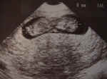 First trimester fetal ultrasound scan