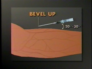 Angle of insertion of an IV