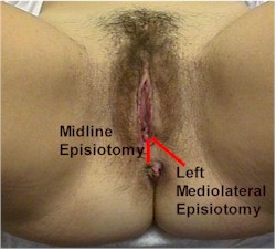 Midline and Left Mediolateral Episiotomy