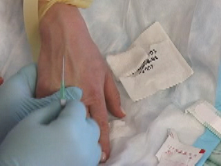 Inserting an IV catheter