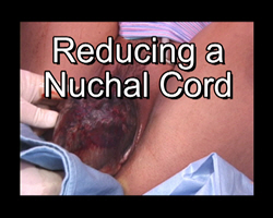 Reducing a Nuchal Cord