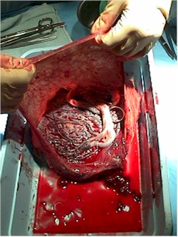 Inspection of the placenta after delivery of the baby