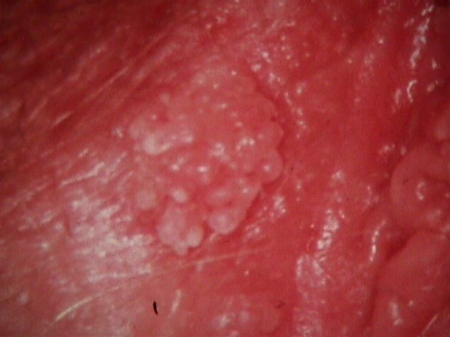 vulva condyloma