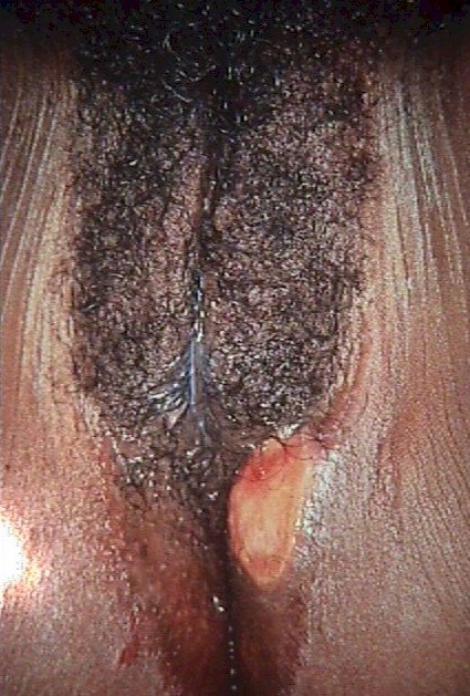 Sudden onset of painful genital ulcers