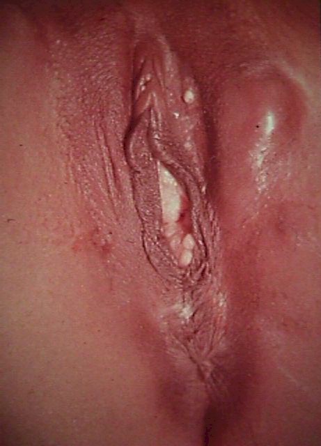 Vaginal Cysts Information